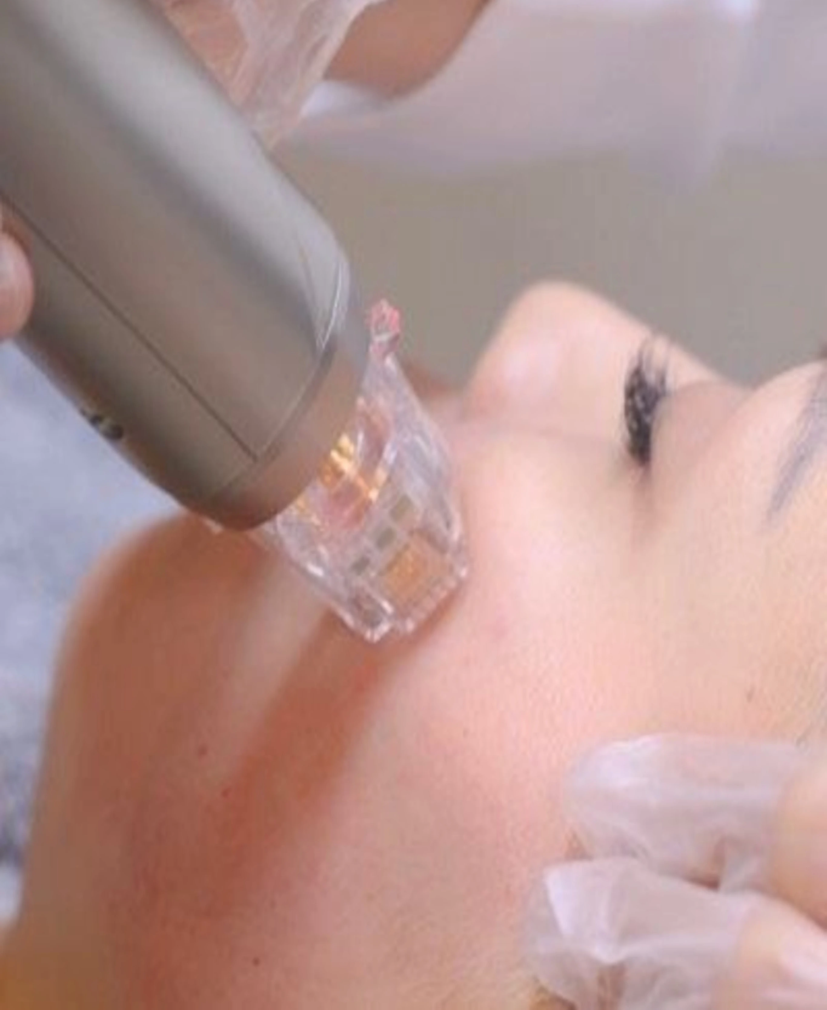 Microneedling